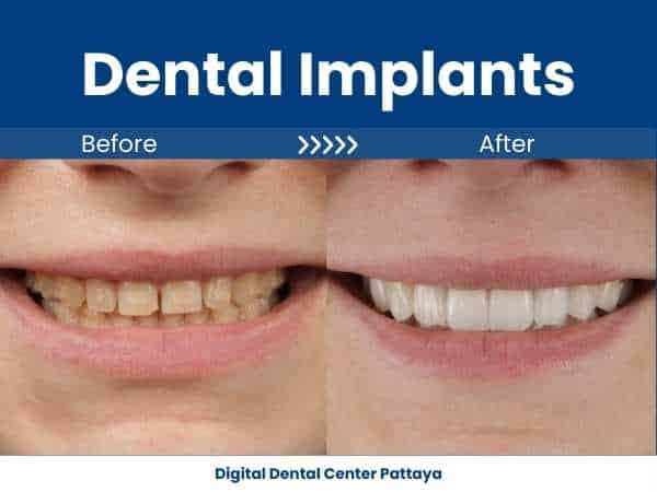 dental implants casses