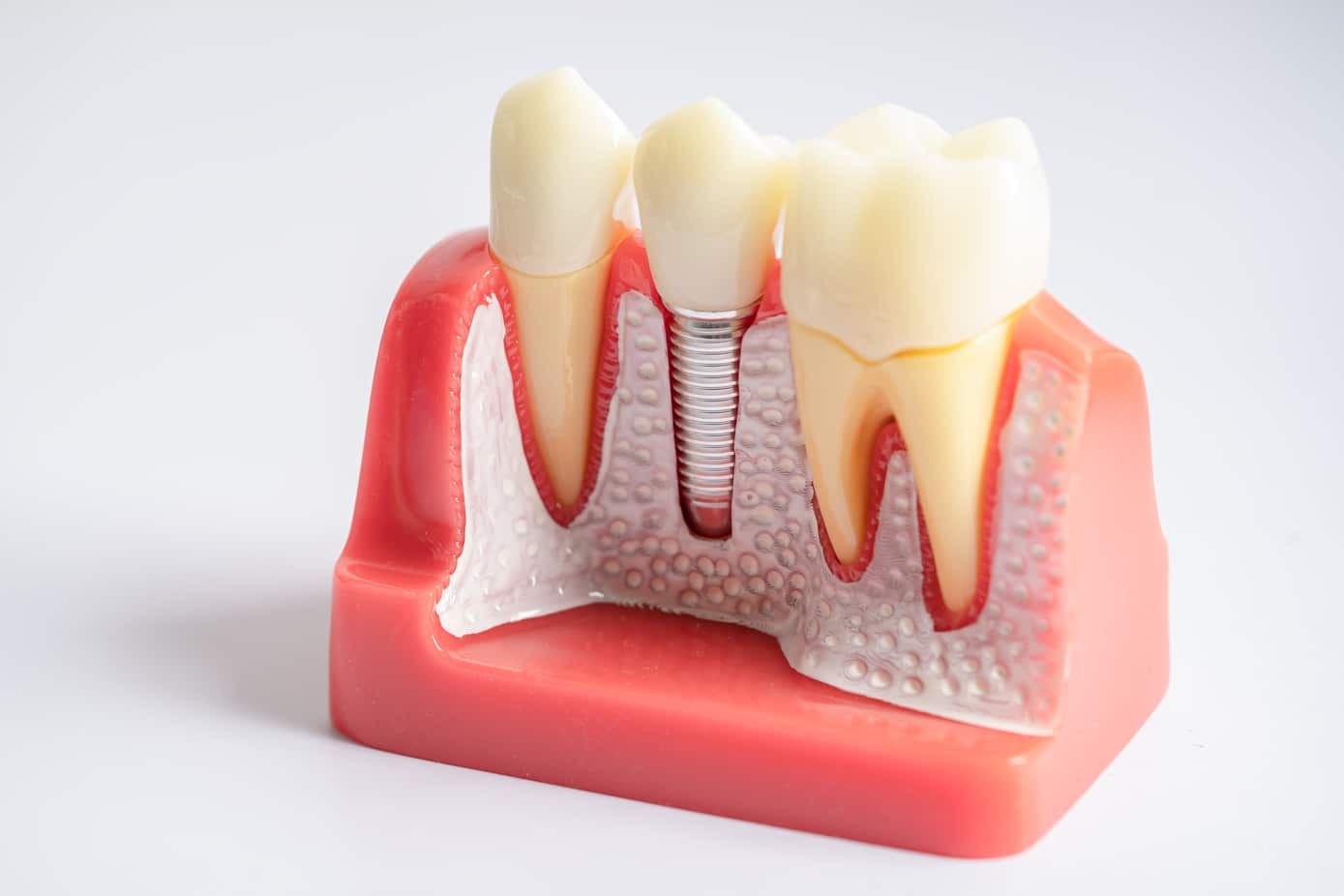 diagram of a dental implant in the jawbone.