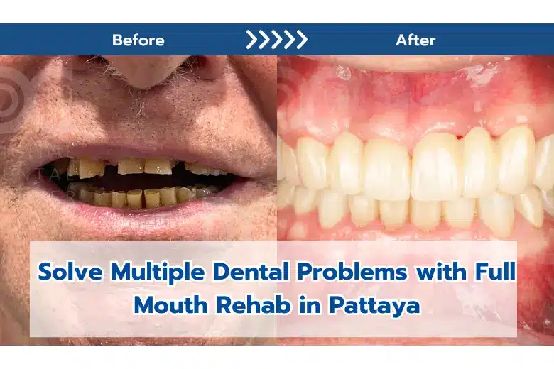 Before and after dental rehab