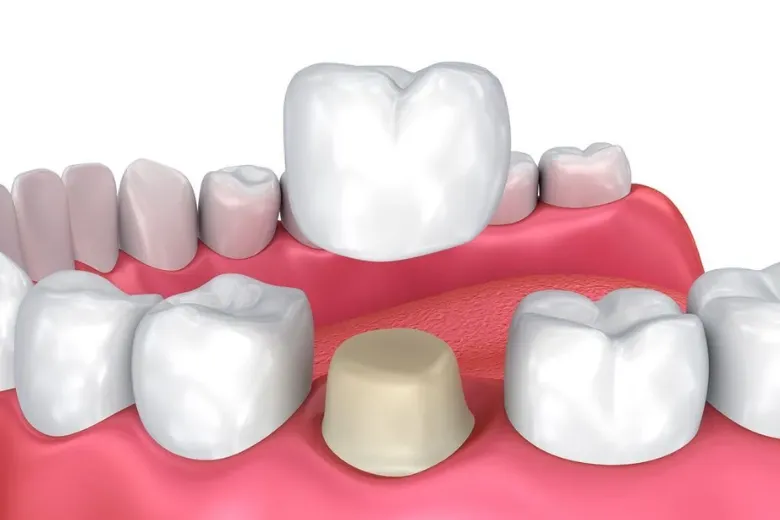 Detailed illustration of a dental crown being prepared and placed.