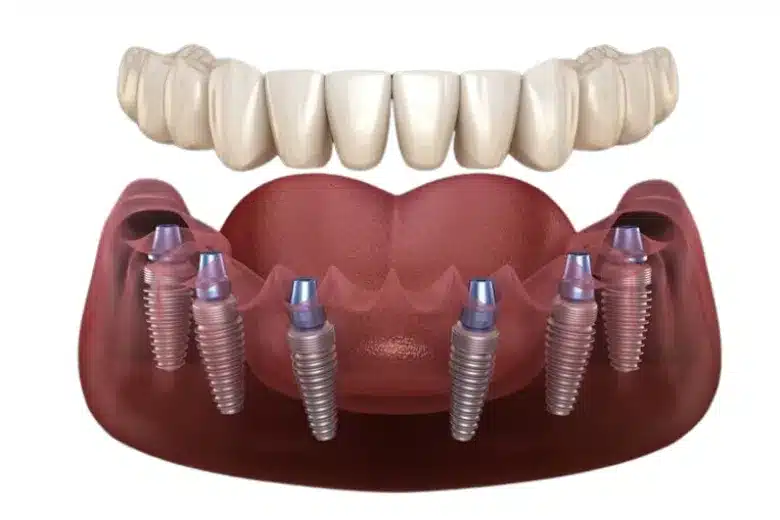 All-On-4 implants in an upper jaw model