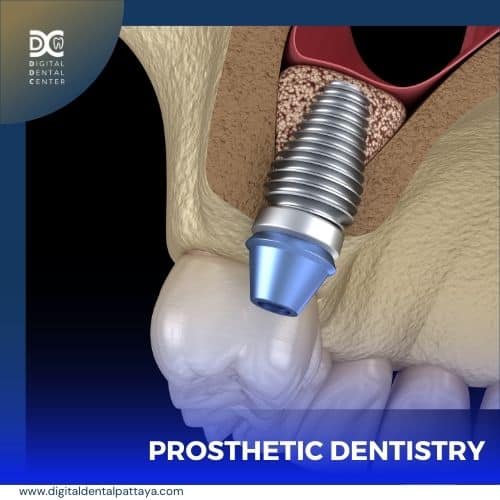 Restore damaged and missing teeth with teeth protheses or false teeth.