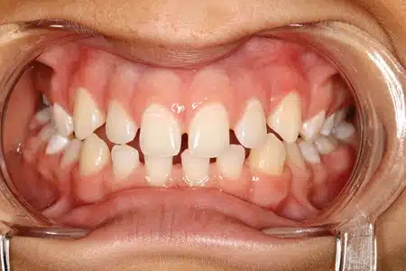 Teeth that are too small-veneers case