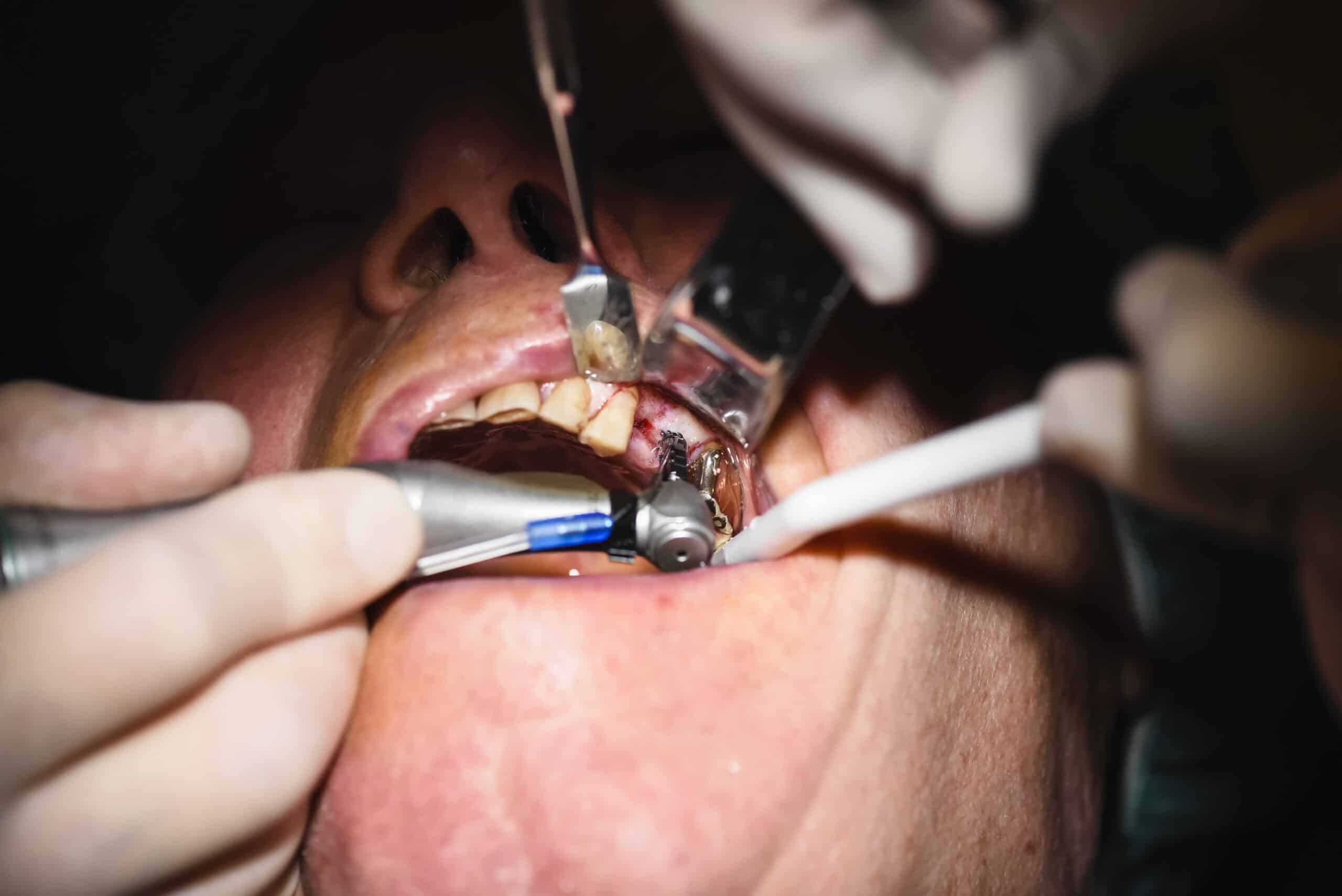 Dental Implant Surgery in Action