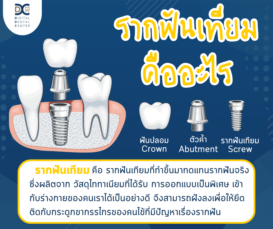 แสดงส่วนประกอบหลักของ รากฟันเทียม