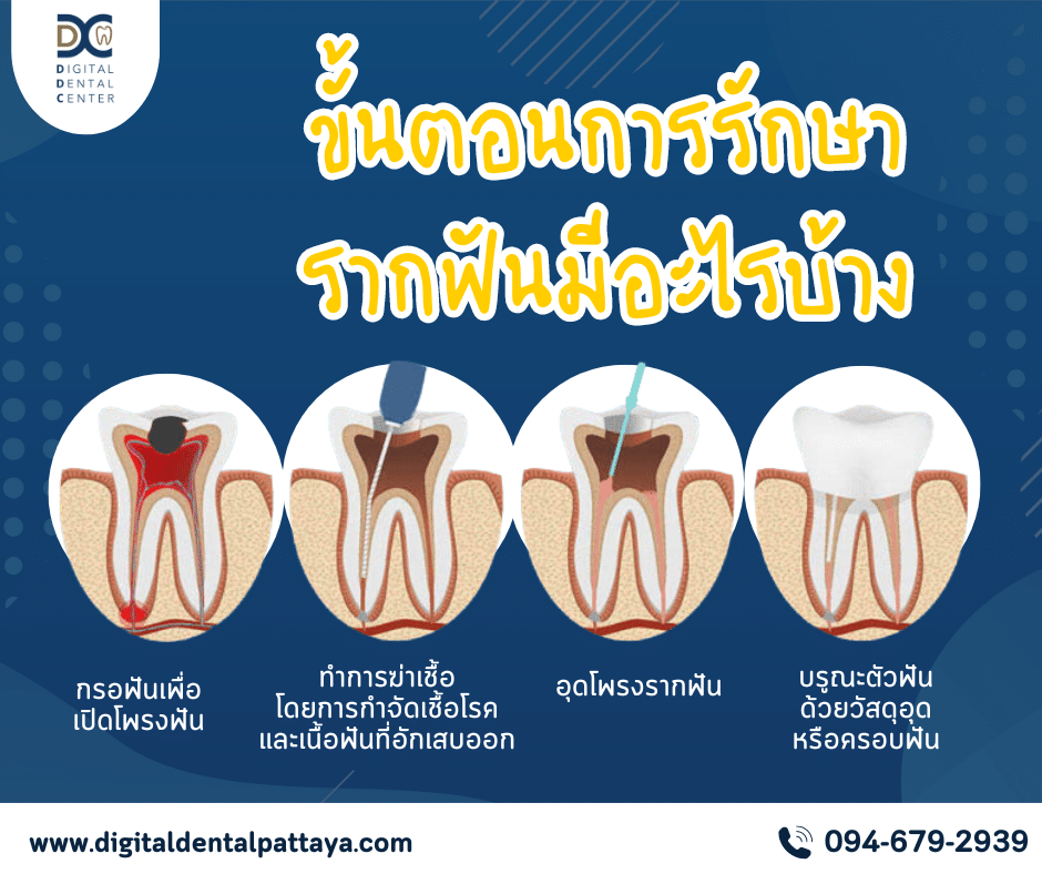 แสดงขั้นตอน การรักษารากฟัน ทีละขั้นตอน 