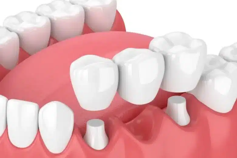 Illustration of three types of dental crowns on teeth.