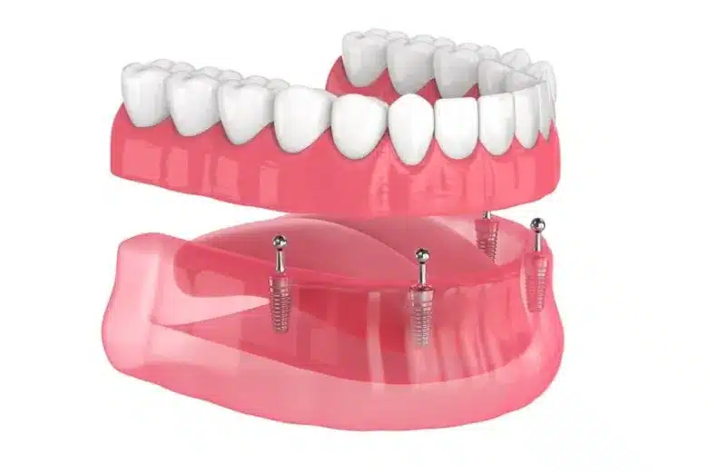 Model of All-On-4 dental implants