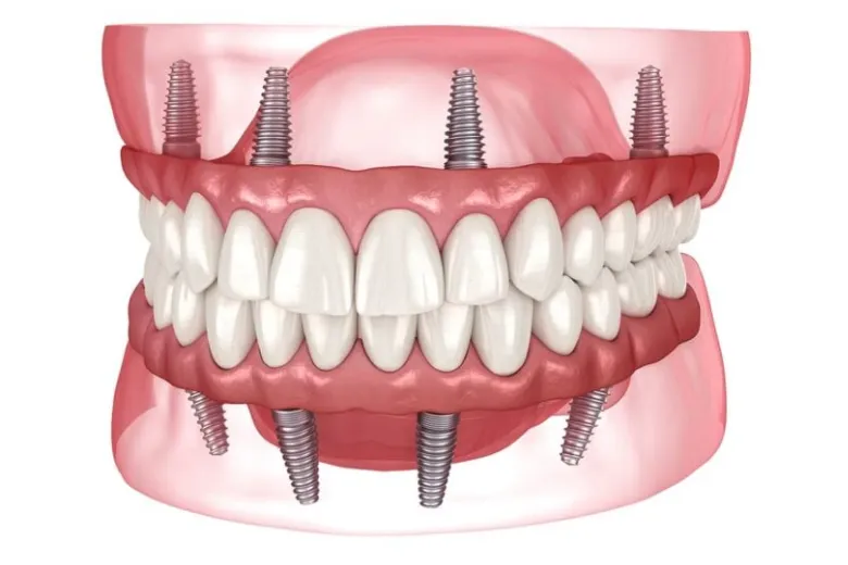 All-On-4 implants in a lower jaw model