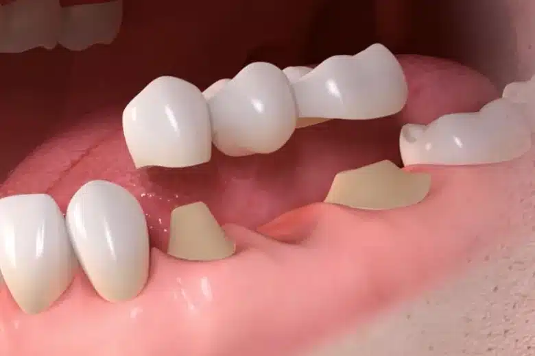 3D visualization showing dental bridges and implants on gums.