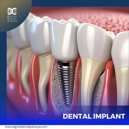 Replace missing teeth with permanent tooth implants.