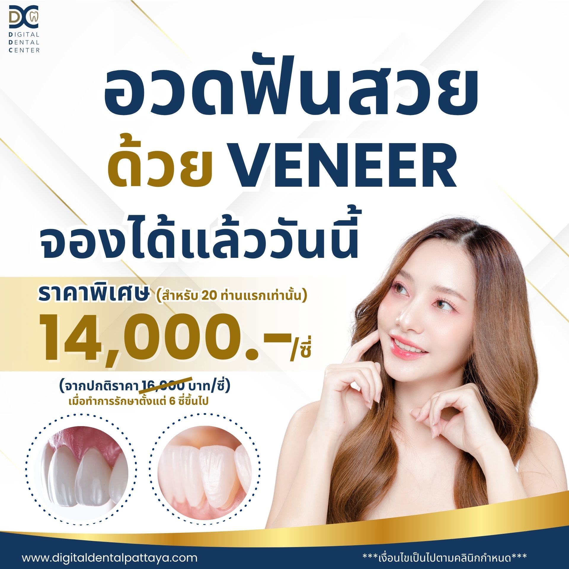 โปรโมชั่น Veneer Pattaya