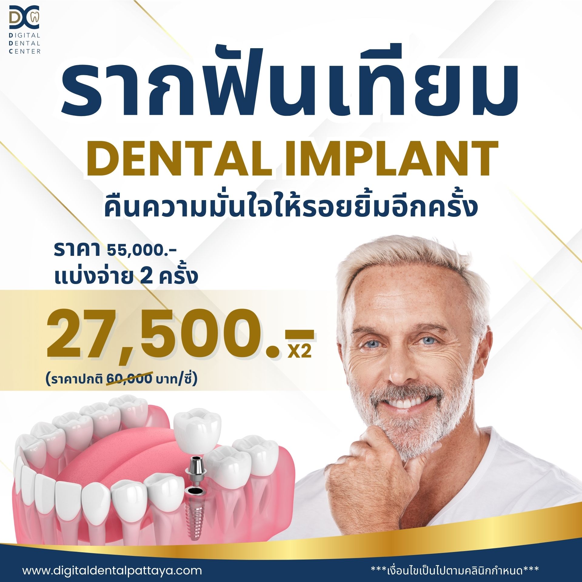 โปรโมชั่นรากฟันเทียม Dental Implants pattaya Promotion