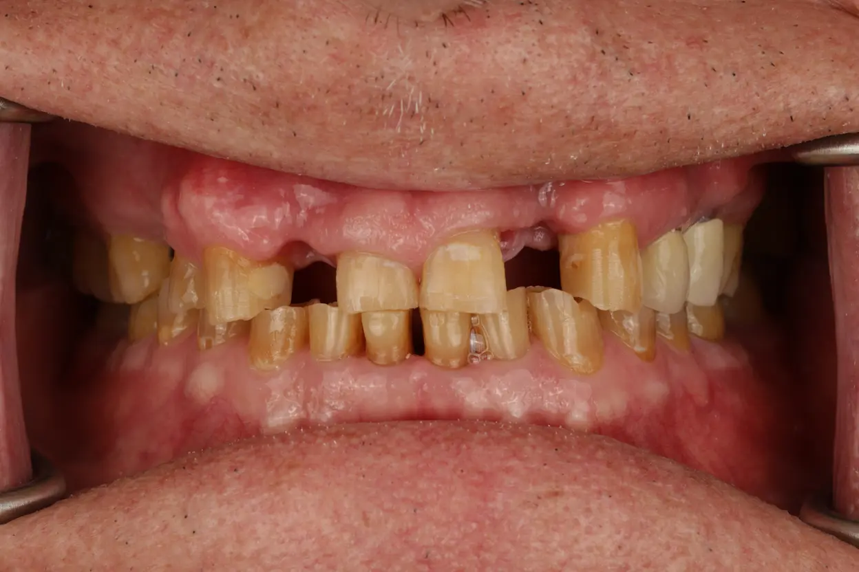 before Full Mouth Rehabilitation