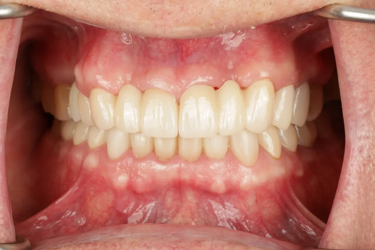 After Full Mouth Rehabilitation treatment