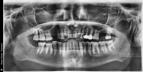 before X-ray Full Mouth Rehabilitation