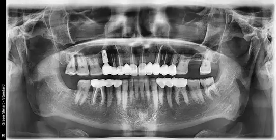 after X-ray Full Mouth Rehabilitation